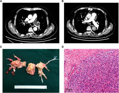 Outcomes of pulmonary endarterectomy for patients with pulmonary artery sarcoma